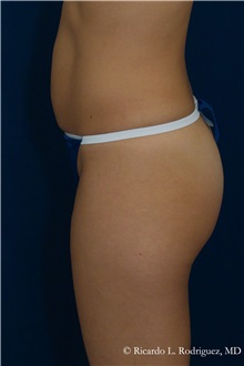Tummy Tuck Before Photo by Ricardo Rodriguez, MD; Lutherville-Timonium, MD - Case 32277