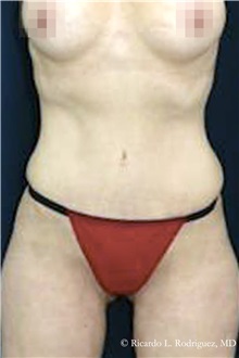 Tummy Tuck After Photo by Ricardo Rodriguez, MD; Lutherville-Timonium, MD - Case 32278