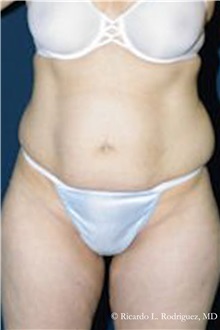 Tummy Tuck Before Photo by Ricardo Rodriguez, MD; Lutherville-Timonium, MD - Case 32278