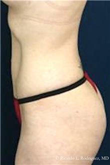 Tummy Tuck After Photo by Ricardo Rodriguez, MD; Lutherville-Timonium, MD - Case 32278