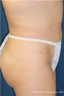 Tummy Tuck After Photo by Ricardo Rodriguez, MD; Lutherville-Timonium, MD - Case 32279