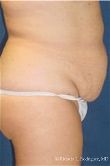 Tummy Tuck Before Photo by Ricardo Rodriguez, MD; Lutherville-Timonium, MD - Case 32279