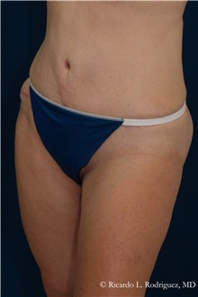 Tummy Tuck After Photo by Ricardo Rodriguez, MD; Lutherville-Timonium, MD - Case 32280