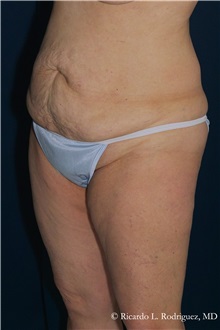 Tummy Tuck Before Photo by Ricardo Rodriguez, MD; Lutherville-Timonium, MD - Case 32280
