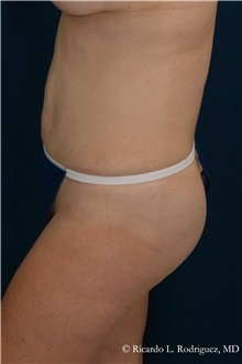 Tummy Tuck After Photo by Ricardo Rodriguez, MD; Lutherville-Timonium, MD - Case 32280