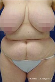 Tummy Tuck Before Photo by Ricardo Rodriguez, MD; Lutherville-Timonium, MD - Case 32281
