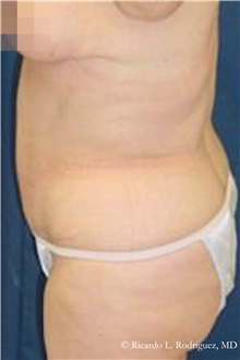 Tummy Tuck After Photo by Ricardo Rodriguez, MD; Lutherville-Timonium, MD - Case 32281