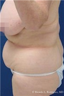 Tummy Tuck Before Photo by Ricardo Rodriguez, MD; Lutherville-Timonium, MD - Case 32281