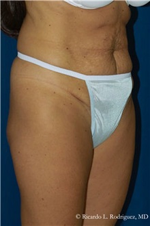 Tummy Tuck Before Photo by Ricardo Rodriguez, MD; Lutherville-Timonium, MD - Case 32282