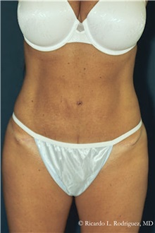 Tummy Tuck After Photo by Ricardo Rodriguez, MD; Lutherville-Timonium, MD - Case 32282