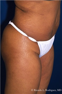 Tummy Tuck After Photo by Ricardo Rodriguez, MD; Lutherville-Timonium, MD - Case 32284