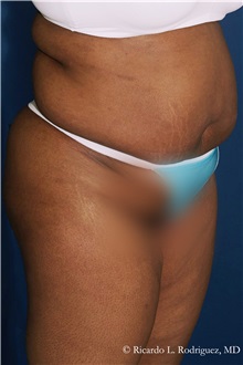 Tummy Tuck Before Photo by Ricardo Rodriguez, MD; Lutherville-Timonium, MD - Case 32284
