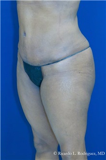 Tummy Tuck After Photo by Ricardo Rodriguez, MD; Lutherville-Timonium, MD - Case 32285