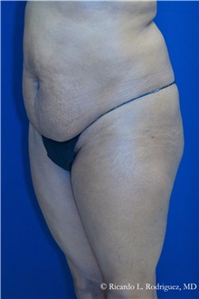 Tummy Tuck Before Photo by Ricardo Rodriguez, MD; Lutherville-Timonium, MD - Case 32285
