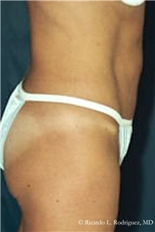 Tummy Tuck After Photo by Ricardo Rodriguez, MD; Lutherville-Timonium, MD - Case 32286