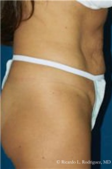 Tummy Tuck Before Photo by Ricardo Rodriguez, MD; Lutherville-Timonium, MD - Case 32286