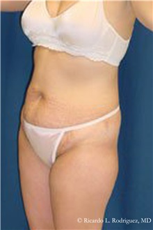 Tummy Tuck Before Photo by Ricardo Rodriguez, MD; Lutherville-Timonium, MD - Case 32287