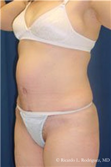 Tummy Tuck After Photo by Ricardo Rodriguez, MD; Lutherville-Timonium, MD - Case 32288