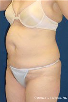 Tummy Tuck Before Photo by Ricardo Rodriguez, MD; Lutherville-Timonium, MD - Case 32288