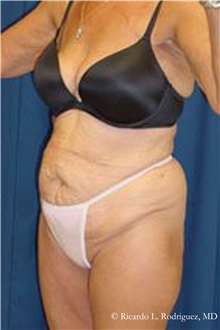 Tummy Tuck Before Photo by Ricardo Rodriguez, MD; Lutherville-Timonium, MD - Case 32289