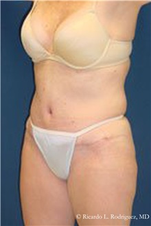 Tummy Tuck After Photo by Ricardo Rodriguez, MD; Lutherville-Timonium, MD - Case 32290