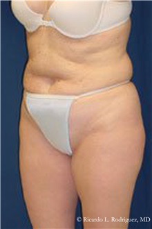 Tummy Tuck Before Photo by Ricardo Rodriguez, MD; Lutherville-Timonium, MD - Case 32290