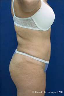 Tummy Tuck After Photo by Ricardo Rodriguez, MD; Lutherville-Timonium, MD - Case 32292