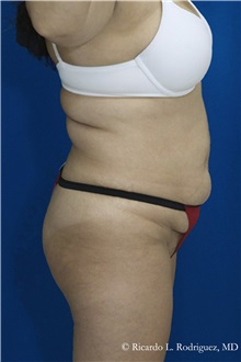 Tummy Tuck Before Photo by Ricardo Rodriguez, MD; Lutherville-Timonium, MD - Case 32292
