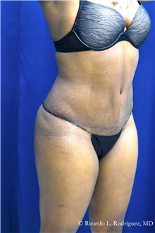 Tummy Tuck After Photo by Ricardo Rodriguez, MD; Lutherville-Timonium, MD - Case 32293