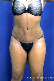 Tummy Tuck After Photo by Ricardo Rodriguez, MD; Lutherville-Timonium, MD - Case 32293