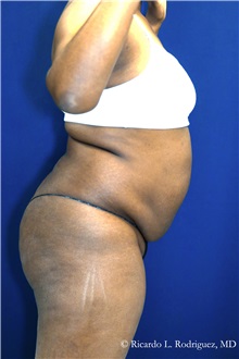 Tummy Tuck Before Photo by Ricardo Rodriguez, MD; Lutherville-Timonium, MD - Case 32293