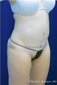 Tummy Tuck After Photo by Ricardo Rodriguez, MD; Lutherville-Timonium, MD - Case 32294