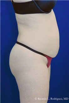 Tummy Tuck Before Photo by Ricardo Rodriguez, MD; Lutherville-Timonium, MD - Case 32294