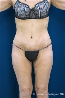 Tummy Tuck After Photo by Ricardo Rodriguez, MD; Lutherville-Timonium, MD - Case 32295