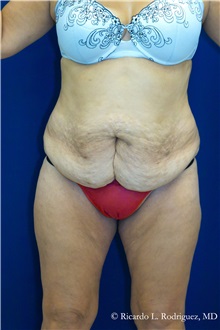Tummy Tuck Before Photo by Ricardo Rodriguez, MD; Lutherville-Timonium, MD - Case 32295