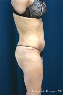 Tummy Tuck After Photo by Ricardo Rodriguez, MD; Lutherville-Timonium, MD - Case 32295