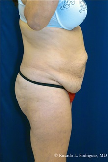Tummy Tuck Before Photo by Ricardo Rodriguez, MD; Lutherville-Timonium, MD - Case 32295