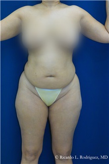 Tummy Tuck Before Photo by Ricardo Rodriguez, MD; Lutherville-Timonium, MD - Case 32296