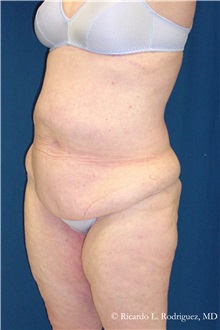 Body Lift Before Photo by Ricardo Rodriguez, MD; Lutherville-Timonium, MD - Case 32401