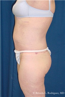 Body Lift After Photo by Ricardo Rodriguez, MD; Lutherville-Timonium, MD - Case 32401