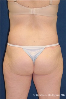 Body Lift After Photo by Ricardo Rodriguez, MD; Lutherville-Timonium, MD - Case 32402