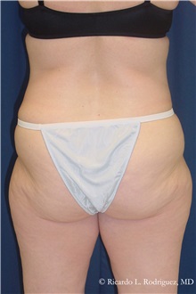 Body Lift Before Photo by Ricardo Rodriguez, MD; Lutherville-Timonium, MD - Case 32402