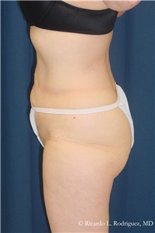 Body Lift Before Photo by Ricardo Rodriguez, MD; Lutherville-Timonium, MD - Case 32402