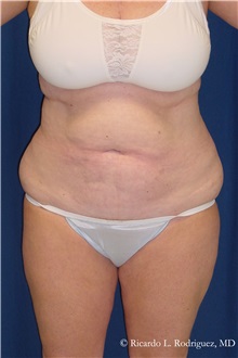 Body Lift Before Photo by Ricardo Rodriguez, MD; Lutherville-Timonium, MD - Case 32404