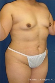 Body Lift Before Photo by Ricardo Rodriguez, MD; Lutherville-Timonium, MD - Case 32405