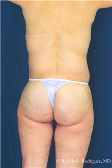 Body Lift After Photo by Ricardo Rodriguez, MD; Lutherville-Timonium, MD - Case 32406