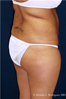 Body Lift Before Photo by Ricardo Rodriguez, MD; Lutherville-Timonium, MD - Case 32407