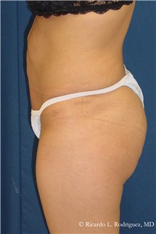 Body Lift After Photo by Ricardo Rodriguez, MD; Lutherville-Timonium, MD - Case 32407