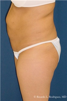 Body Lift Before Photo by Ricardo Rodriguez, MD; Lutherville-Timonium, MD - Case 32407