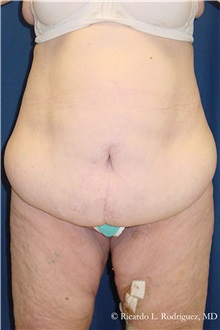 Body Lift Before Photo by Ricardo Rodriguez, MD; Lutherville-Timonium, MD - Case 32409